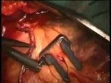 جراحی قلب باز - www.irshafa.ir