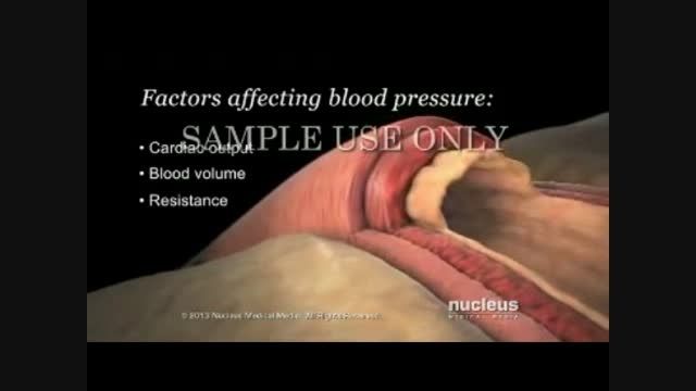 بیماری فشار خون