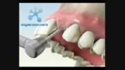 جراحی کاشت ایمپلنت تک دندان
