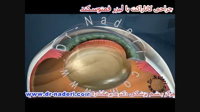 عمل جراحی فیکو با فمتوسکند لیزر-مرکزچشم پزشکی دکترنادری