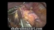 عمل جراحی لاپاروسکوپی آشالازی توسط دکتر شهرام نظری