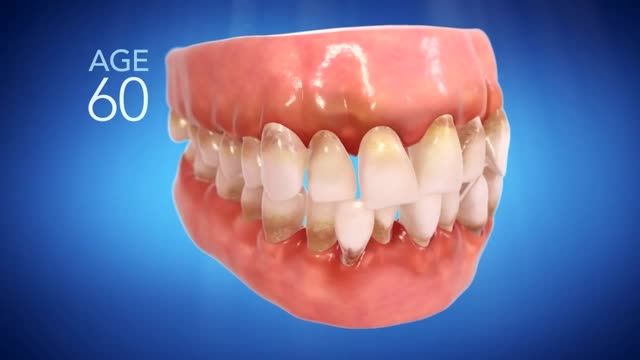 Invisalign Commercial