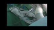 جراحی سنگ کلیه با روش بسته یا PCNL توسط دکتر موسی نژاد