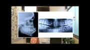 درمان با کیفیت با سیستم دیمون -  همراه با کشیدن دندان