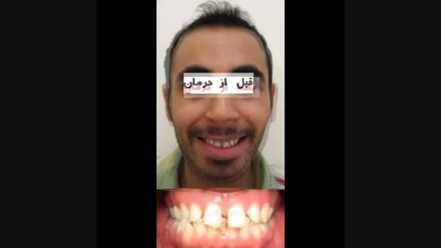 قبل و بعد ارتودنسی -فاصله دندان ها و كراس بایت