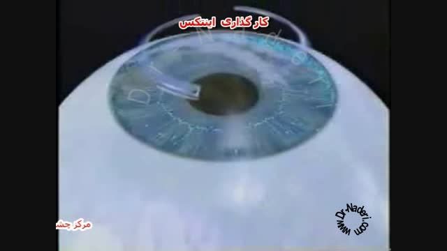 رینگ داخل قرنیه INTACS-سایت چشم پزشکی دکترعلیرضا ناد ری