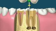مراحل درمان ریشه دندان ( عصب کشی )