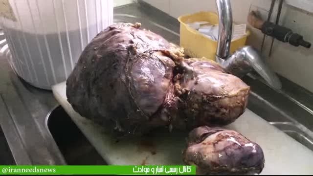 فیلم خارج کردن بزرگترین تومور 8 کیلویی جهان در ایران