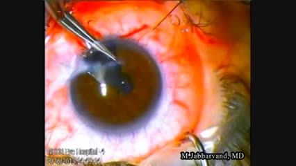 ترمیم مردمک چشم   Pupiloplasty