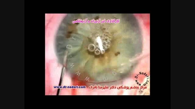 جراحی لنز آرتیزان- مرکزچشم پزشکی دکتر علیرضا نادری