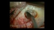 جراحی میکروسکوپی بازسازی کف سینوس از دکتر بهنام شکیبایی
