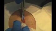 عمل جراحی خروج کیست زیرجلدی از اسکالپ(پوست سر)