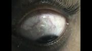 جراحی خروج لوزیازیس چشمی(کرم انگلی در چشم)-دکتر پیوند علامه