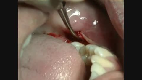 کشیدن (extraction) دندان عقل نهفته Horizontal Impaction