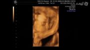 سونوگرافی سه بعدی از تصویر قشنگ نگاه کردن جنین