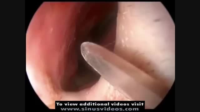 endoscopic septoplasty technique