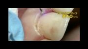 کابرد لیزر در دندانپزشکی