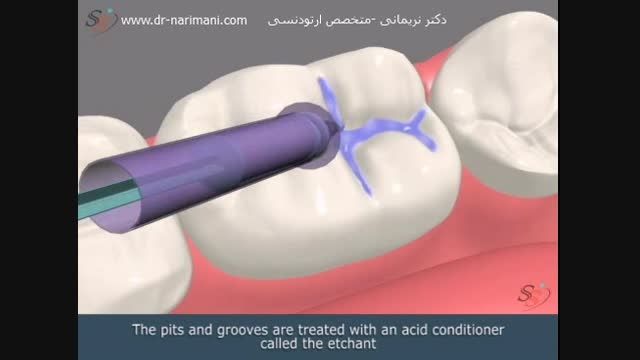 سیلانت و محافظت در برابر پوسیدگی دندان