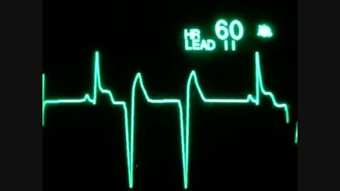 Cardiac Arrest ECG
