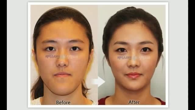 تصاویر قبل و بعد از عمل جراحی پلاستیک