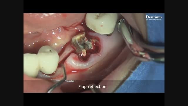 Immediate implantation using Implant Guide