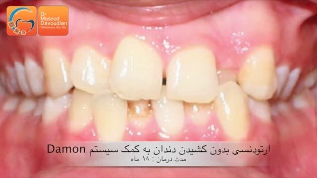 قبل و بعد ارتودنسی نامرتبی دندان|دکتر مسعود داودیان
