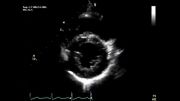 اکوکاردیوگرافی دوبعدی بلادرنگ یک قلب نرمال (ب) - Real-time two-dimensional echocardiography (b)