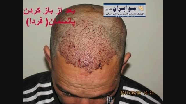 یک نمونه کاشت به روش اف آی تی در کلینیک مو ایران