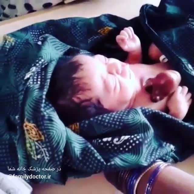 نوزادی که با قلب خارج از بدن به دنیا آمد