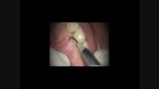 جراحی برداشت بند پشت لب یا frenum با لیزر