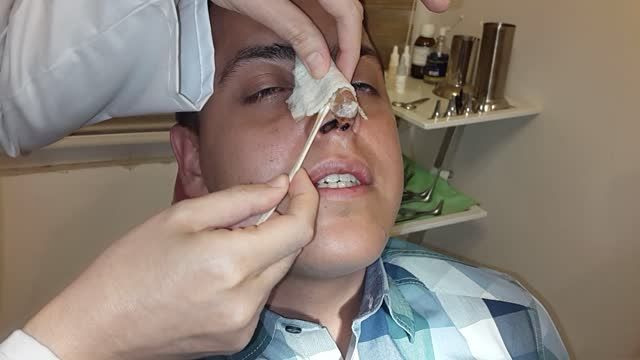 دکترراستا:برداشتن گچ بینی بعداز عمل جراحی