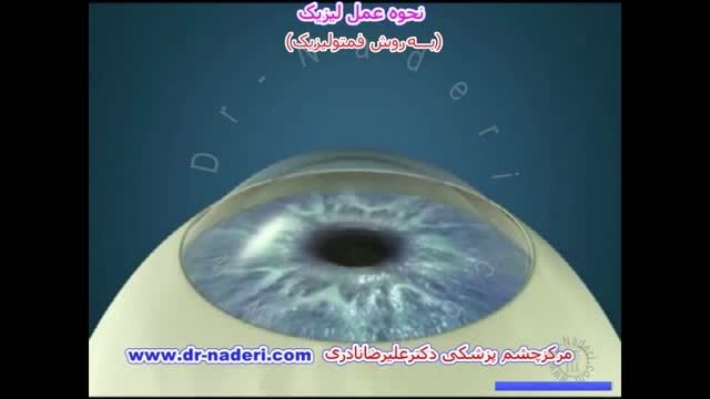 فمتولیزیک - مرکز چشم پزشکی دکتر علیرضا نادری