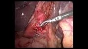 جراحی کله سیستکتومی لاپاروسکوپیک با اکسپلور کلدوک حین عمل