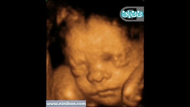 سونوگرافی چهار بعدی در بارداری هفته بیست و نهم