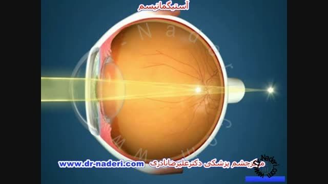 آستیگماتیسم -مرکز چشم پزشکی دکتر علیرضا نادری