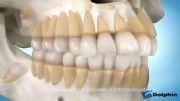 دکتر مسعود داودیان :: دندانهای عقل و ارتودنسی