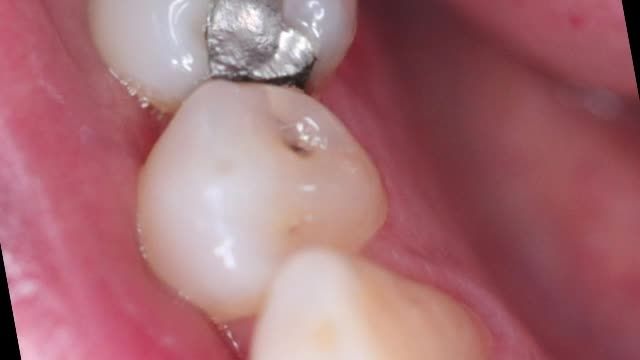 تراش پوسیدگی دندان آسیای کوچک با لیزر و ترمیم