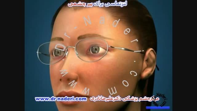لنز تماسی پیرچشمی - مرکز چشم پزشکی دکتر علیرضا نادری