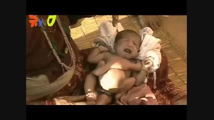 به دنیا آمدن نوزادی عجیب الخلقه در هند