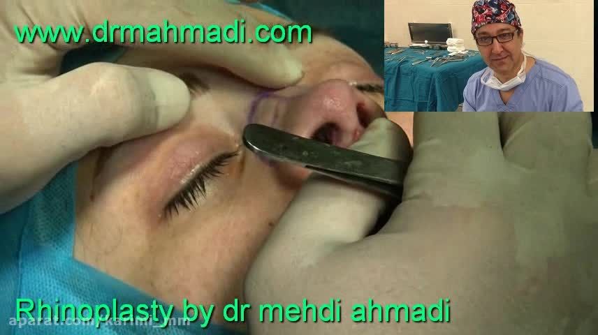 عمل زیبایی بینی(rhinoplasty)توسط متخصص گوش وحلق بینی23