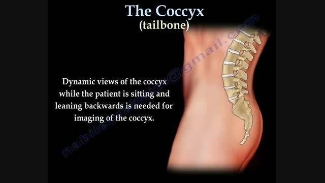 دردهای ناحیه کوکسیژال coccydynia