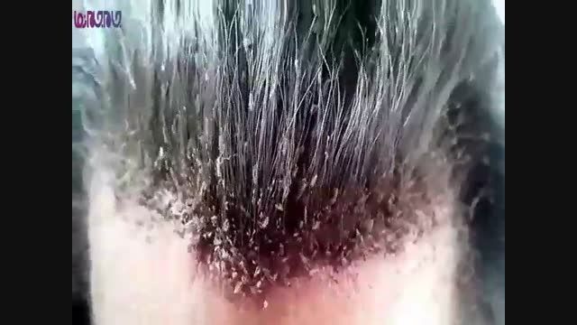 موهایی که معدن شپش است+فیلم کلیپ ویدیو عجیب گلچین صفاسا