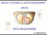 15 ‪ECGTeacher.com - Right Ventricular Hypertrophy (Section 2_ Part 9)‬