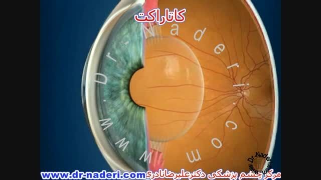 کاتاراکت یاآب مروارید-سایت چشم پزشکی دکتر علیرضا ناد ری