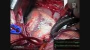 فیلم دفیبریلاسیون داخلی قلبی دچار فیبریلاسیون بطنی