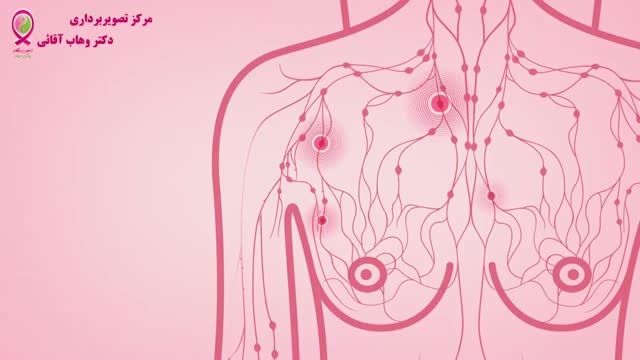 سرطان پستان - قسمت چهارم- رشد سرطان