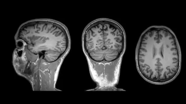 MRI مغز و چاپ آن توسط پرینتر سه بعدی