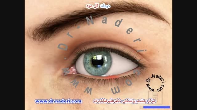 درمان گل مژه - مرکز چشم پزشکی دکتر علیرضا نادری