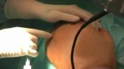 Arthroscopic Shoulder Surgery