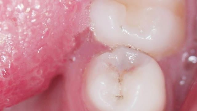 تراش پوسیدگی دندان آسیای کوچک با لیزر و ترمیم